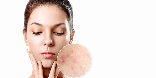 Gözeneklerden Kurtulmanın Yöntemleri