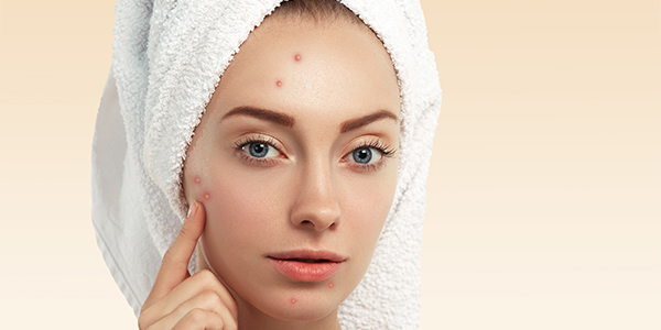 Doğal Çözümlerle Akne Tedavisi