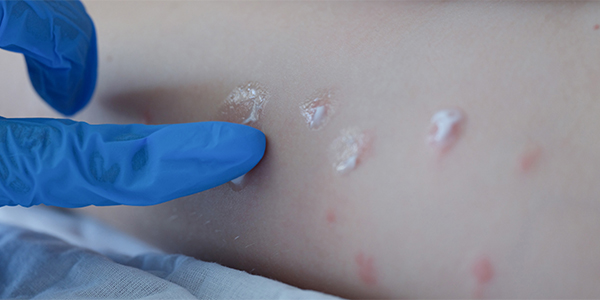 Yaz Aylarında Sık Görülen Deri Hastalıkları