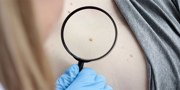 Cilt Kanseri Hakkında Önemli Bilgiler