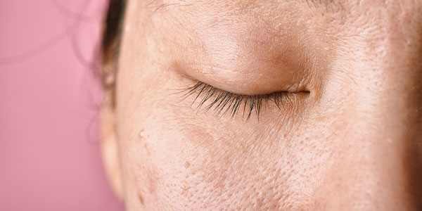 Yağ Bezeleri Hakkında Önemli Bilgiler