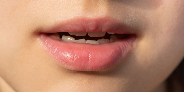 Dudak Üstü Lekeleri Nedir?