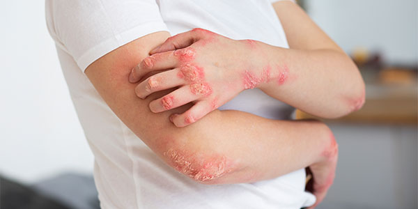 Egzama Hakkında Önemli Bilgiler