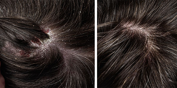 Saç Derisi Aknesi Nedir?